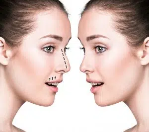 rhinoplasty